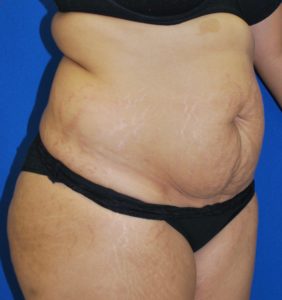 Abdominoplasty (Tummy Tuck) Before and After Pictures Buffalo, NY