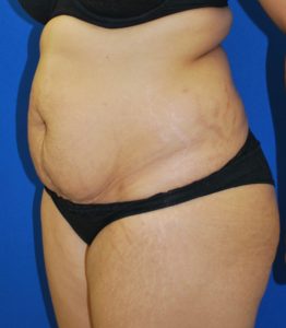 Abdominoplasty (Tummy Tuck) Before and After Pictures Buffalo, NY