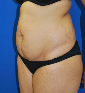 Abdominoplasty (Tummy Tuck) Before and After Pictures Buffalo, NY