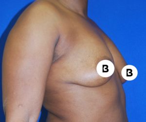 Breast Augmentation Before and After Pictures Buffalo, NY