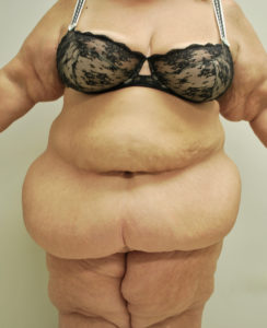 Abdominoplasty (Tummy Tuck) Before and After Pictures Buffalo, NY