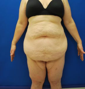 Abdominoplasty (Tummy Tuck) Before and After Pictures Buffalo, NY