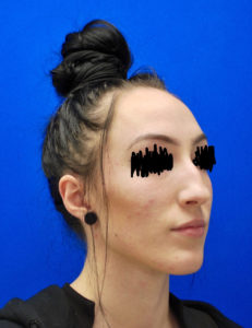 Rhinoplasty (Nose Surgery) Before and After Pictures Buffalo, NY