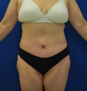 Abdominoplasty (Tummy Tuck) Before and After Pictures Buffalo, NY