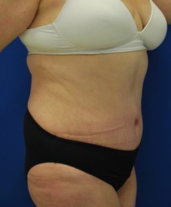 Abdominoplasty (Tummy Tuck) Before and After Pictures Buffalo, NY