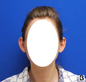 Otoplasty Before and After Pictures Buffalo, NY