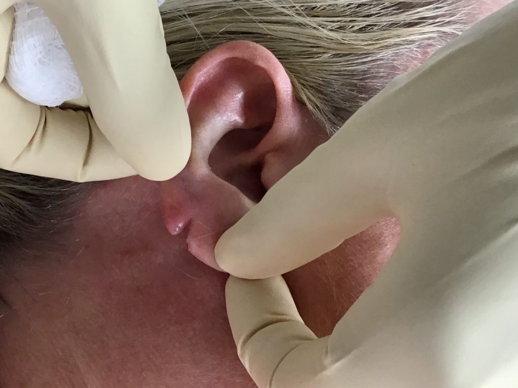 Earlobe Reconstruction Before and After Pictures Buffalo, NY