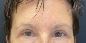 Blepharoplasty (Eyelid Surgery) Before and After Pictures in Buffalo, NY