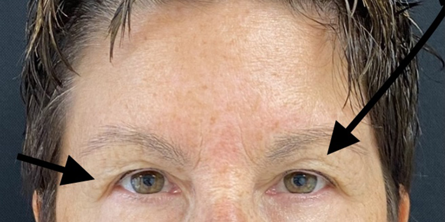 Blepharoplasty (Eyelid Surgery) Before and After Pictures in Buffalo, NY