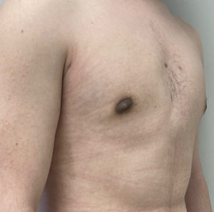 Gynecomastia (Male Chest Surgery) Before and After Pictures in Buffalo, NY