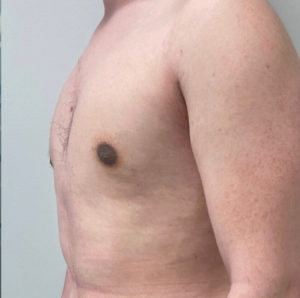 Gynecomastia (Male Chest Surgery) Before and After Pictures in Buffalo, NY