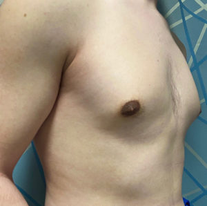 Gynecomastia (Male Chest Surgery) Before and After Pictures in Buffalo, NY