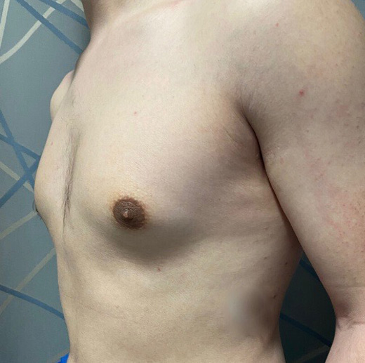 Gynecomastia (Male Chest Surgery) Before and After Pictures in Buffalo, NY