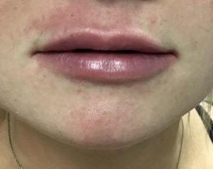 Lip Fillers Before and After Pictures Buffalo, NY