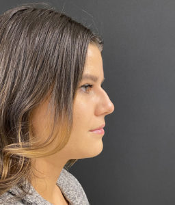 Liquid Rhinoplasty Before and After Pictures in Buffalo, NY