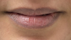 Lip Fillers Before and After Pictures in Buffalo, NY