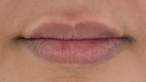 Lip Fillers Before and After Pictures in Buffalo, NY