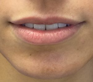 Fillers Before and After Pictures Buffalo, NY