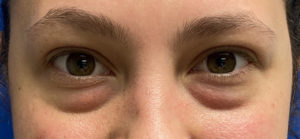 Tear Trough Fillers Before and After Pictures Buffalo, NY
