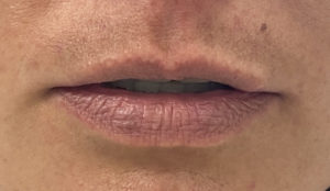 Lip Fillers Before and After Pictures Buffalo, NY