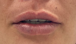 Lip Fillers Before and After Pictures Buffalo, NY