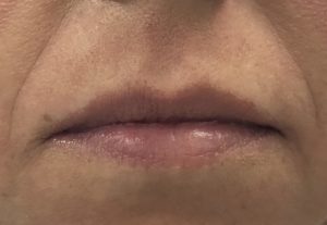 Fillers Before and After Pictures Buffalo, NY