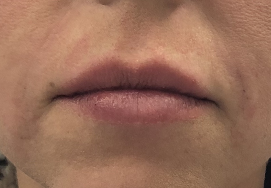 Fillers Before and After Pictures Buffalo, NY