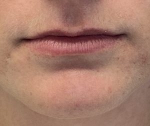 Lip Fillers Before and After Pictures Buffalo, NY