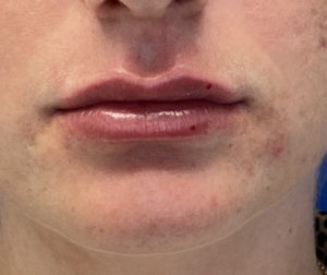 Lip Fillers Before and After Pictures Buffalo, NY