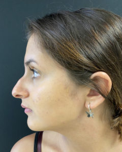 Liquid Rhinoplasty Before and After Pictures Buffalo, NY