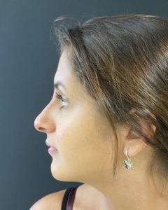 Liquid Rhinoplasty Before and After Pictures Buffalo, NY