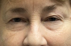 Blepharoplasty Before and After Pictures Buffalo, NY