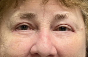 Blepharoplasty Before and After Pictures Buffalo, NY