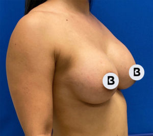 Breast Augmentation Before and After Pictures Buffalo, NY