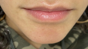 Lip Fillers Before and After Pictures Buffalo, NY