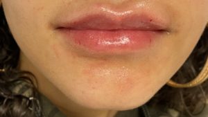 Lip Fillers Before and After Pictures Buffalo, NY