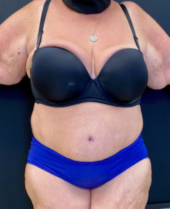 Abdominoplasty (Tummy Tuck) Before and After Pictures Buffalo, NY