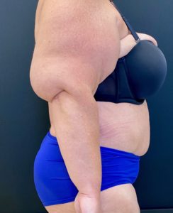 Abdominoplasty (Tummy Tuck) Before and After Pictures Buffalo, NY