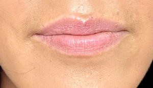 Lip Fillers Before and After Pictures Buffalo, NY