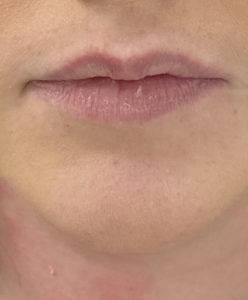 Lip Fillers Before and After Pictures Buffalo, NY