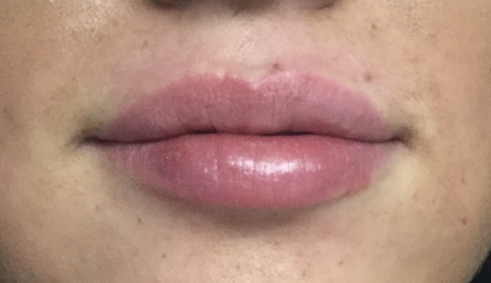 Lip Fillers Before and After Pictures Buffalo, NY