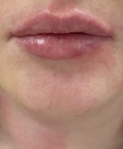 Lip Fillers Before and After Pictures Buffalo, NY