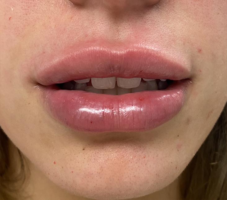 Fillers Before and After Pictures Buffalo, NY