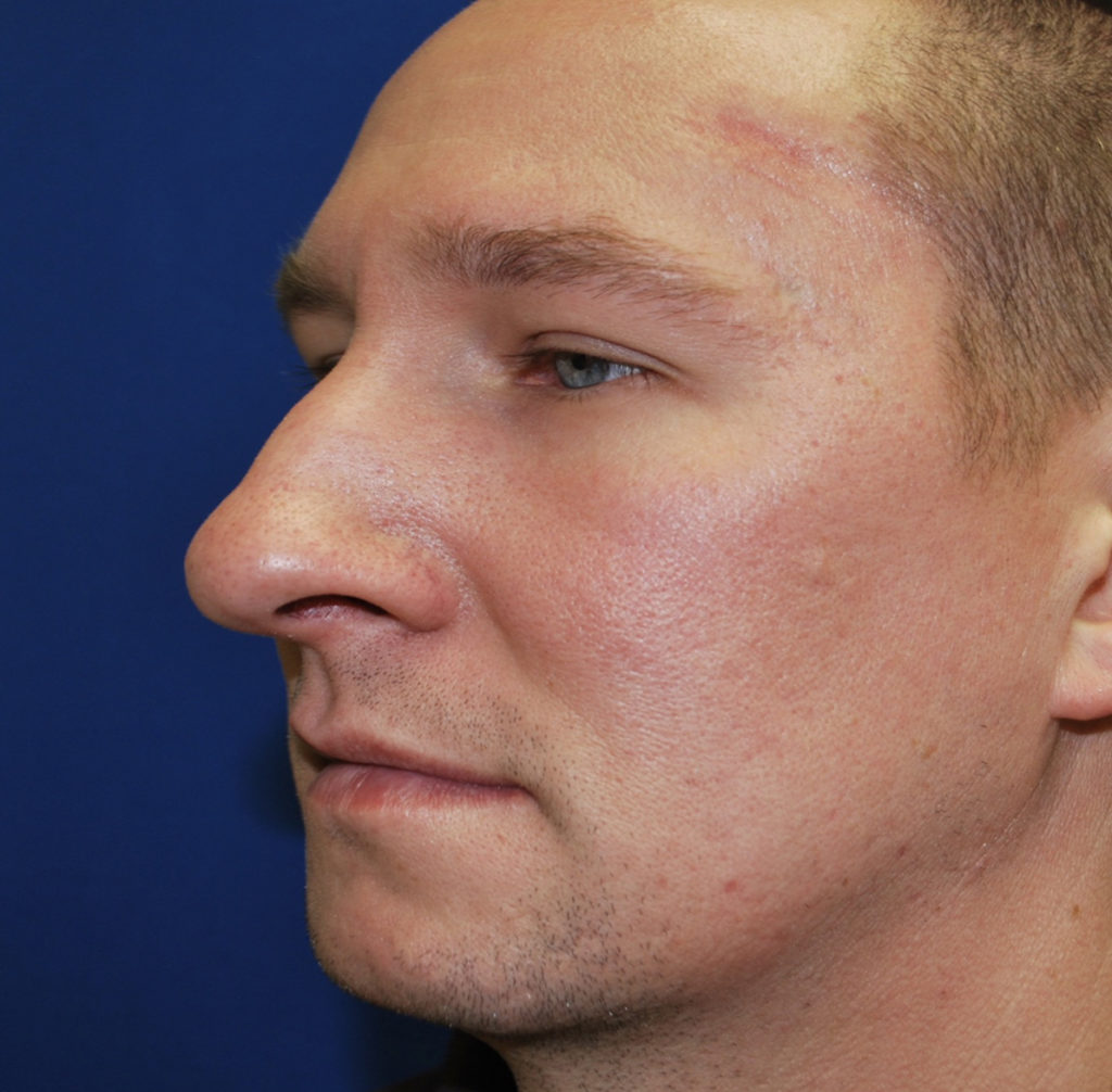 Rhinoplasty (Nose Surgery) Before and After Pictures Buffalo, NY