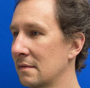 Rhinoplasty (Nose Surgery) Before and After Pictures Buffalo, NY
