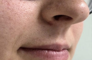 Mole Removal Before and After Pictures Buffalo, NY