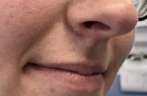 Mole Removal Before and After Pictures Buffalo, NY