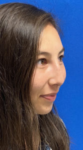 Liquid Rhinoplasty Before and After Pictures Buffalo, NY