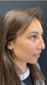 Liquid Rhinoplasty Before and After Pictures Buffalo, NY