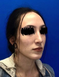 Rhinoplasty (Nose Surgery) Before and After Pictures Buffalo, NY